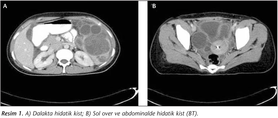 Nadir Bir Olgu Tuboovaryan Apseye Neden Olan Hidatik Kist